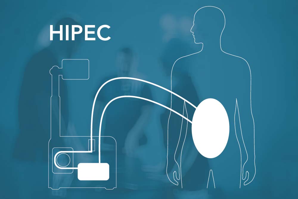 cytoreductieve chirurgie gecombineerd met HIPEC laat betere uitkomsten zien